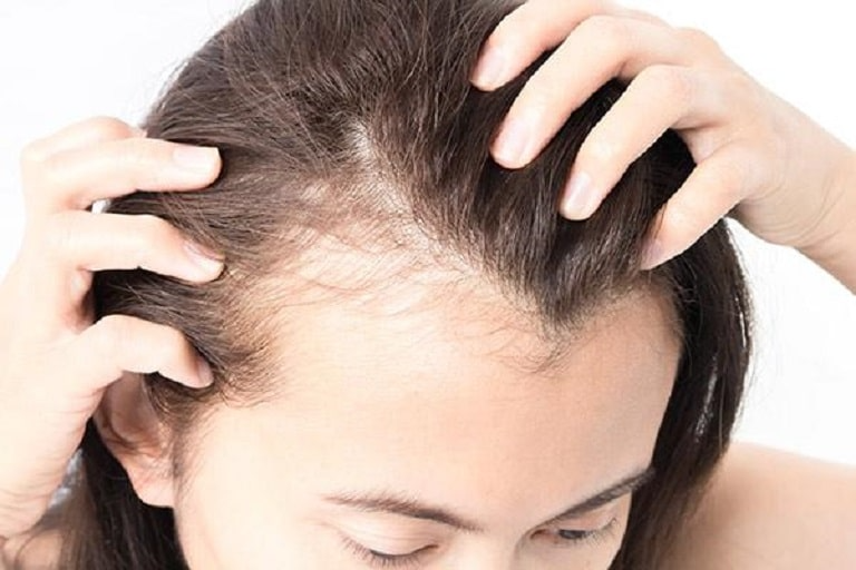 Rụng tóc từng mảng: Nguyên nhân & Cách khắc phục